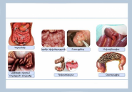 Intestinal obstruction