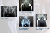 Клинический случай: эндопротезирование во время псориатического артрита и двустороннего коксартроза