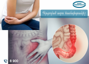 Irritable bowel syndrome