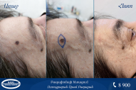 Basal cell carcinoma of the skin (basalioma)